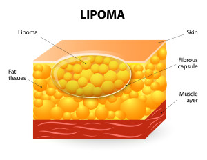 Lipoma treatment minnesota
