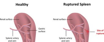 Ruptured Spleen