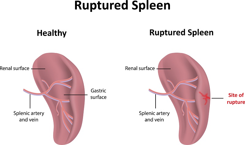 Ruptured Spleen