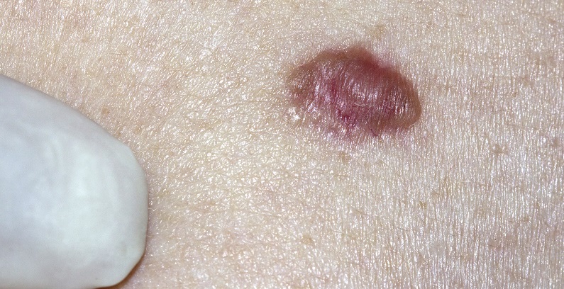 Basal-Cell-Carcinoma